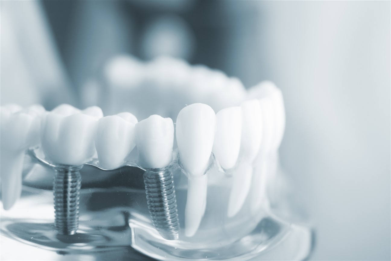 Dental implants Edmonton